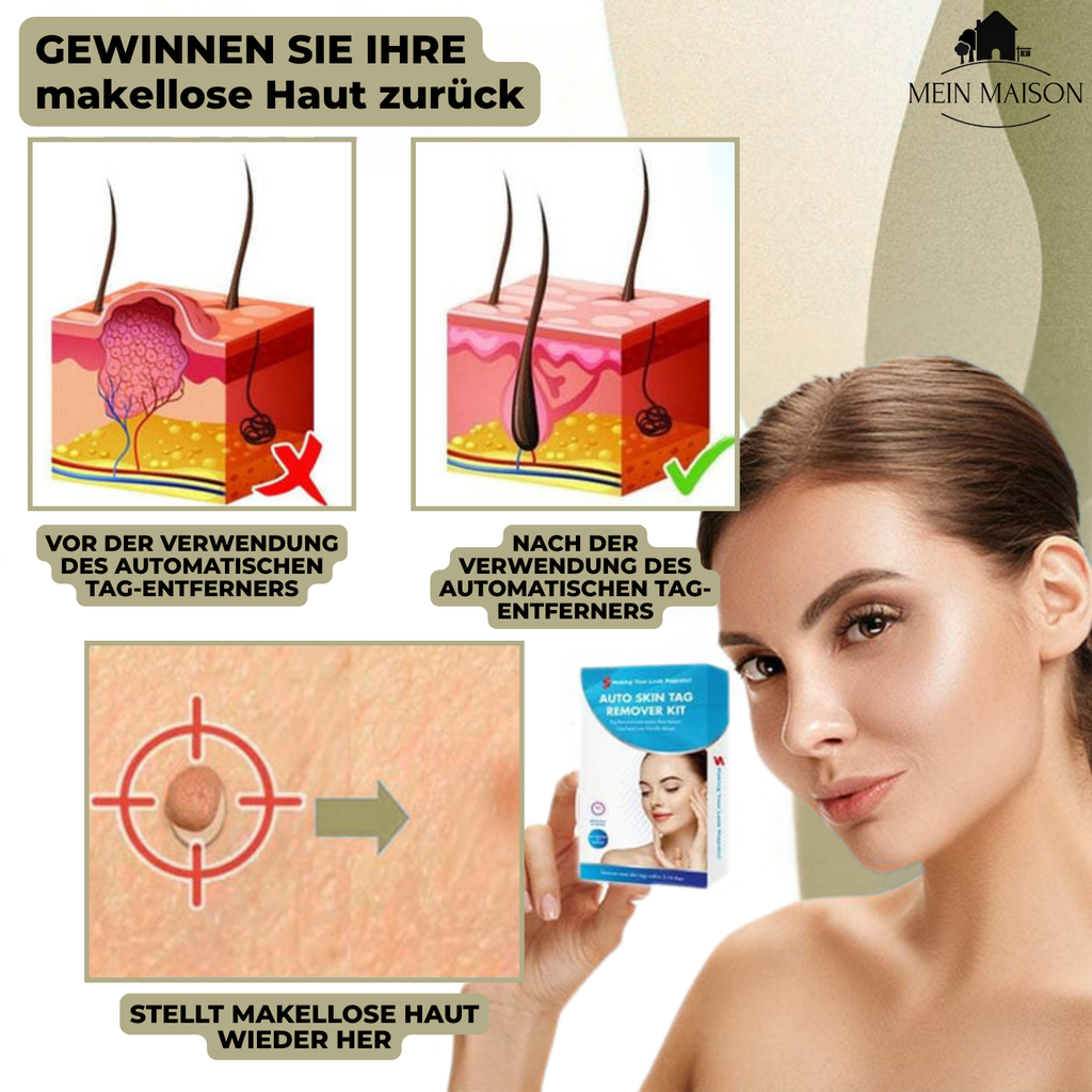 siopsrl | DermaLinx Wart Remover | Pain-Free Removal of Warts & Moles | For Home | Without Surgery