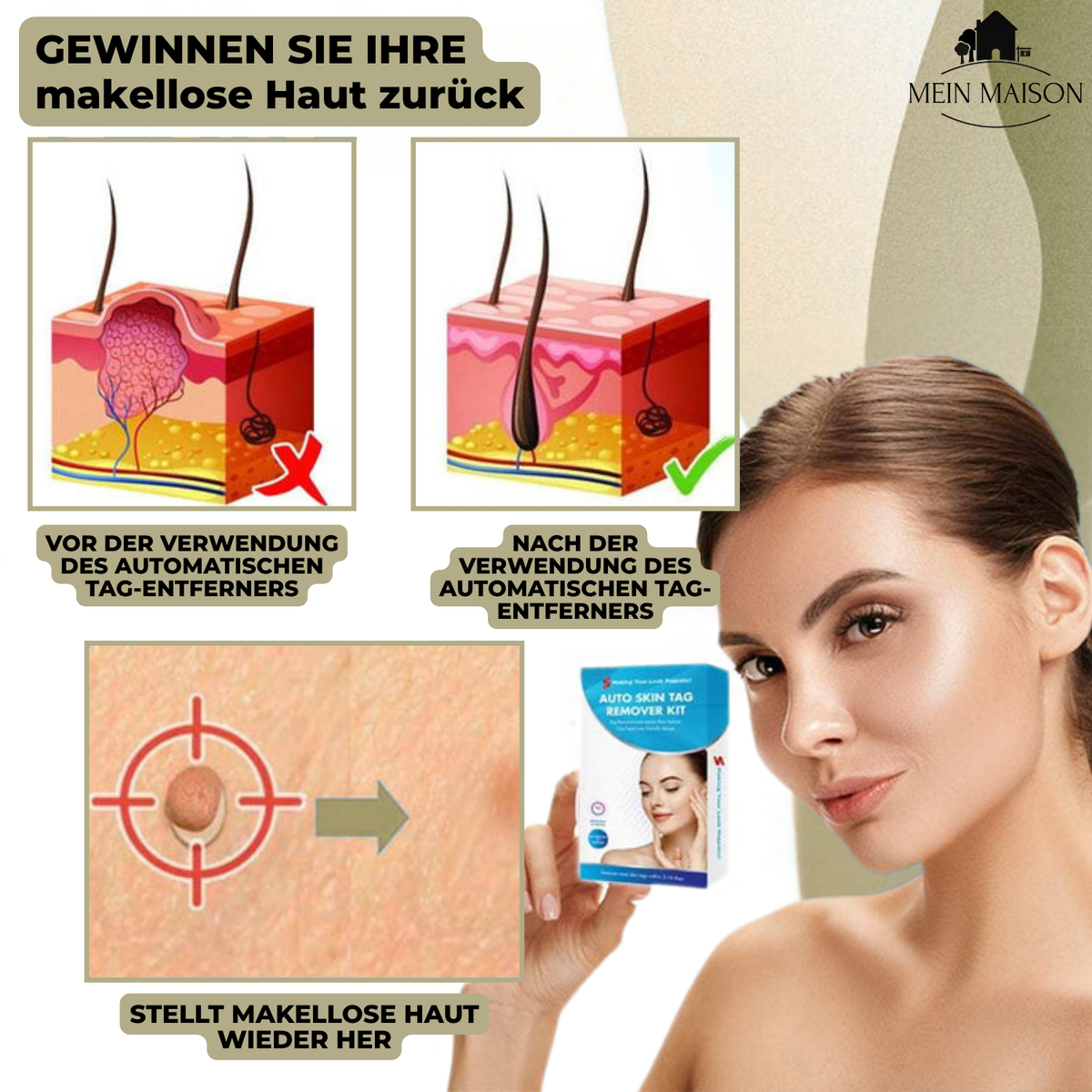 siopsrl | DermaLinx Wart Remover | Pain-Free Removal of Warts & Moles | For Home | Without Surgery