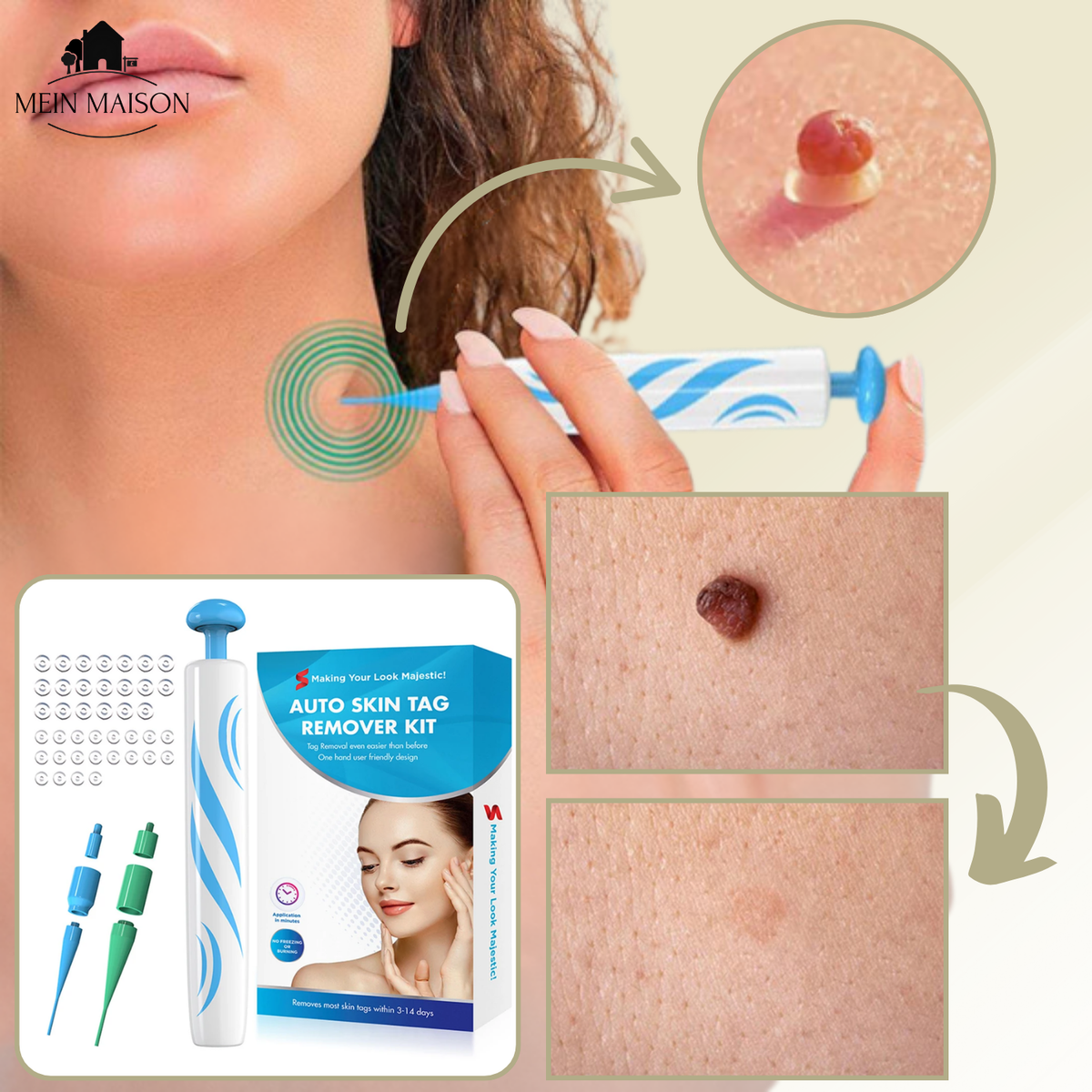 siopsrl | DermaLinx Wart Remover | Pain-Free Removal of Warts & Moles | For Home | Without Surgery