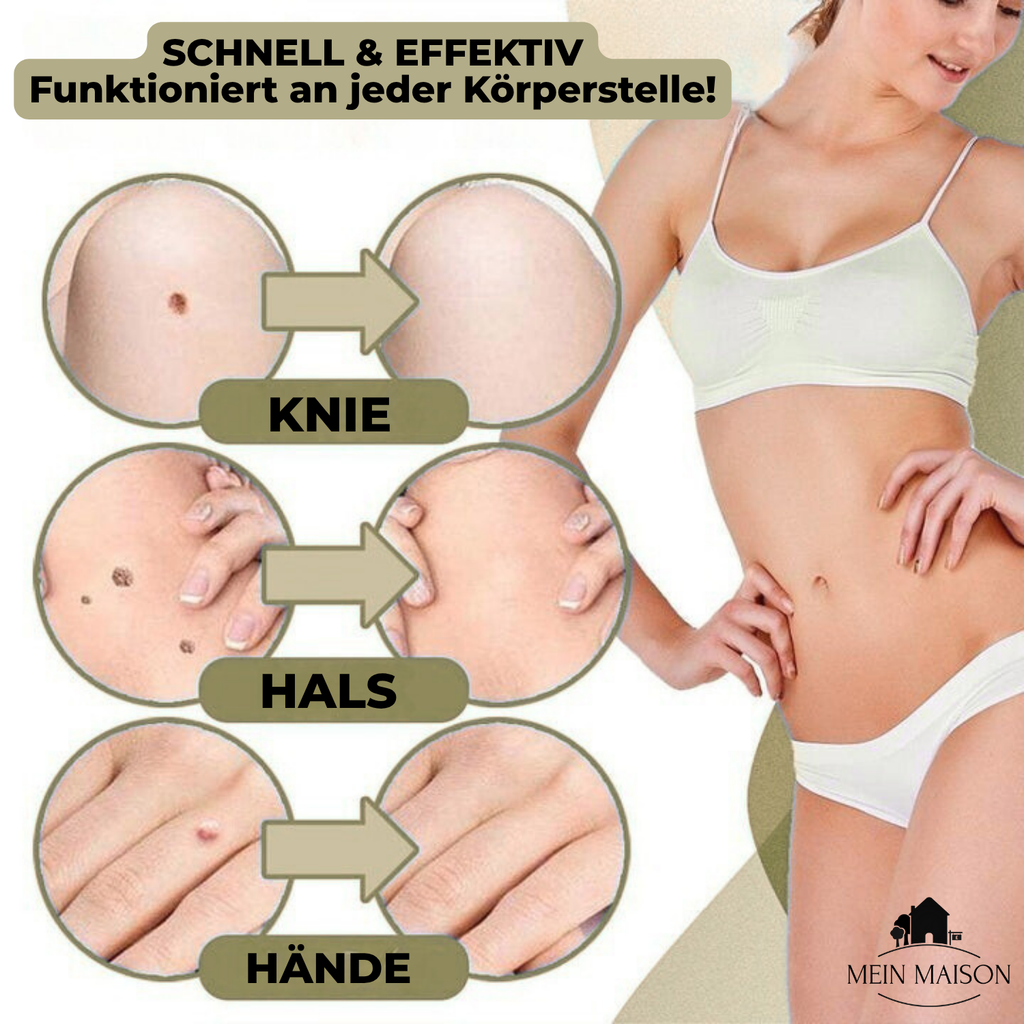 siopsrl | DermaLinx Wart Remover | Pain-Free Removal of Warts & Moles | For Home | Without Surgery