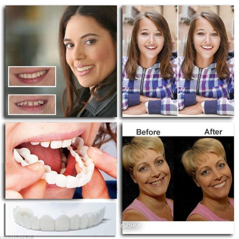 siopsrl | Snap-On Dentures