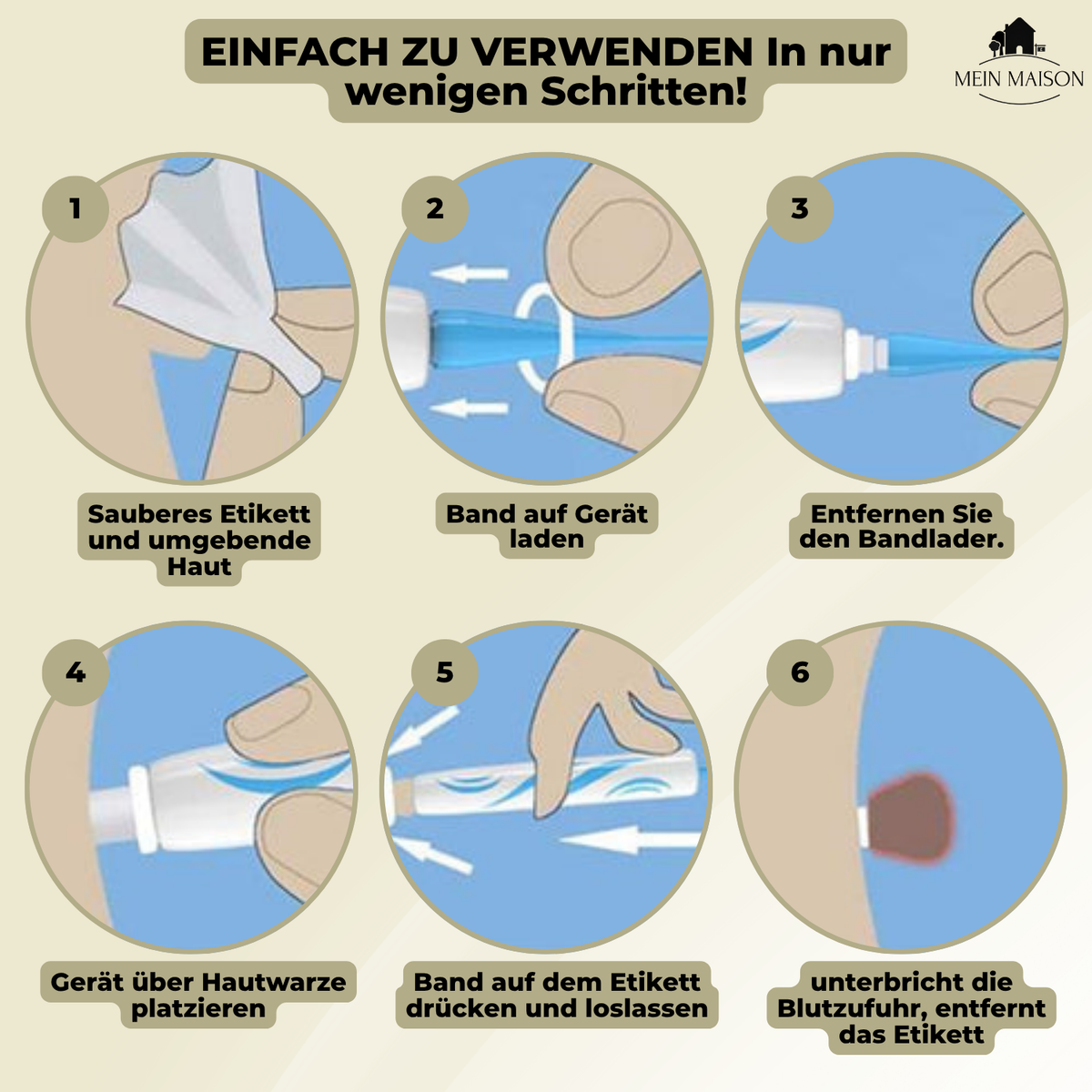 siopsrl | DermaLinx Wart Remover | Pain-Free Removal of Warts & Moles | For Home | Without Surgery