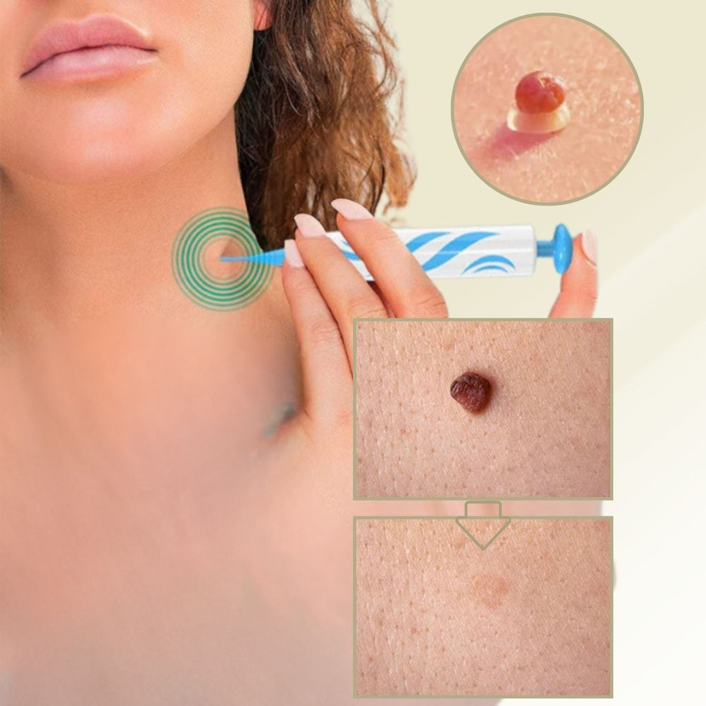 siopsrl | DermaLinx Wart Remover | Pain-Free Removal of Warts & Moles | For Home | Without Surgery